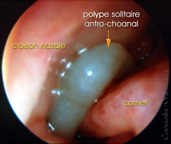 polype nasale